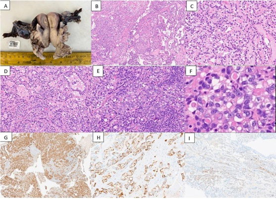 Clear cell adenocarcinoma of the cervix, a rare entity of young females: A case report
