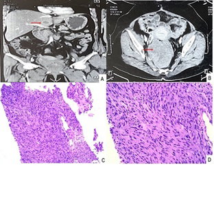 Cytological Diagnosis of Hepatic Metastasis from Rectal Gastrointestinal Stromal Tumor: A Case Report
