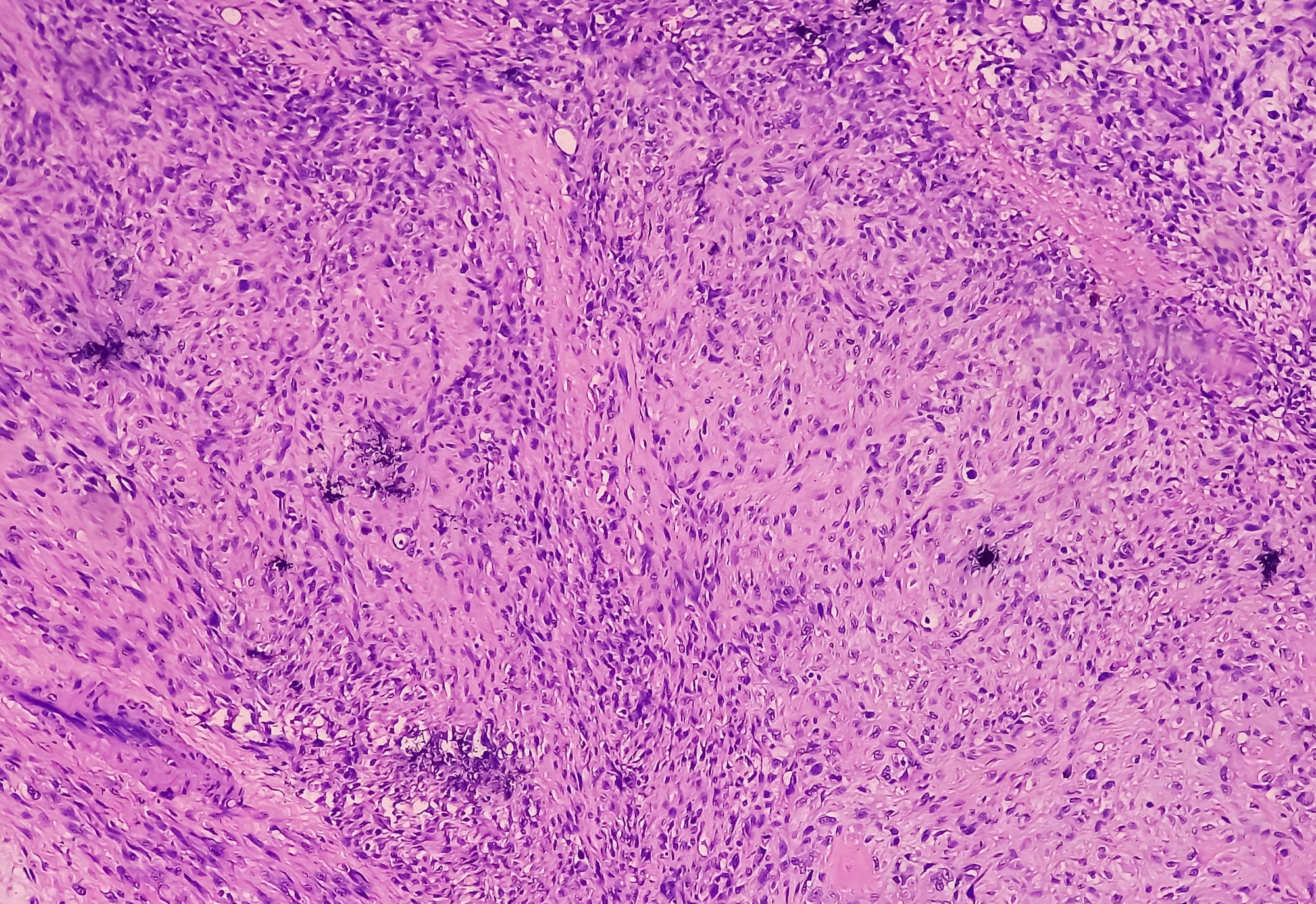 Low-grade fibromyxoid sarcoma, a rare tumor at an unusual site: Case report and review of literature