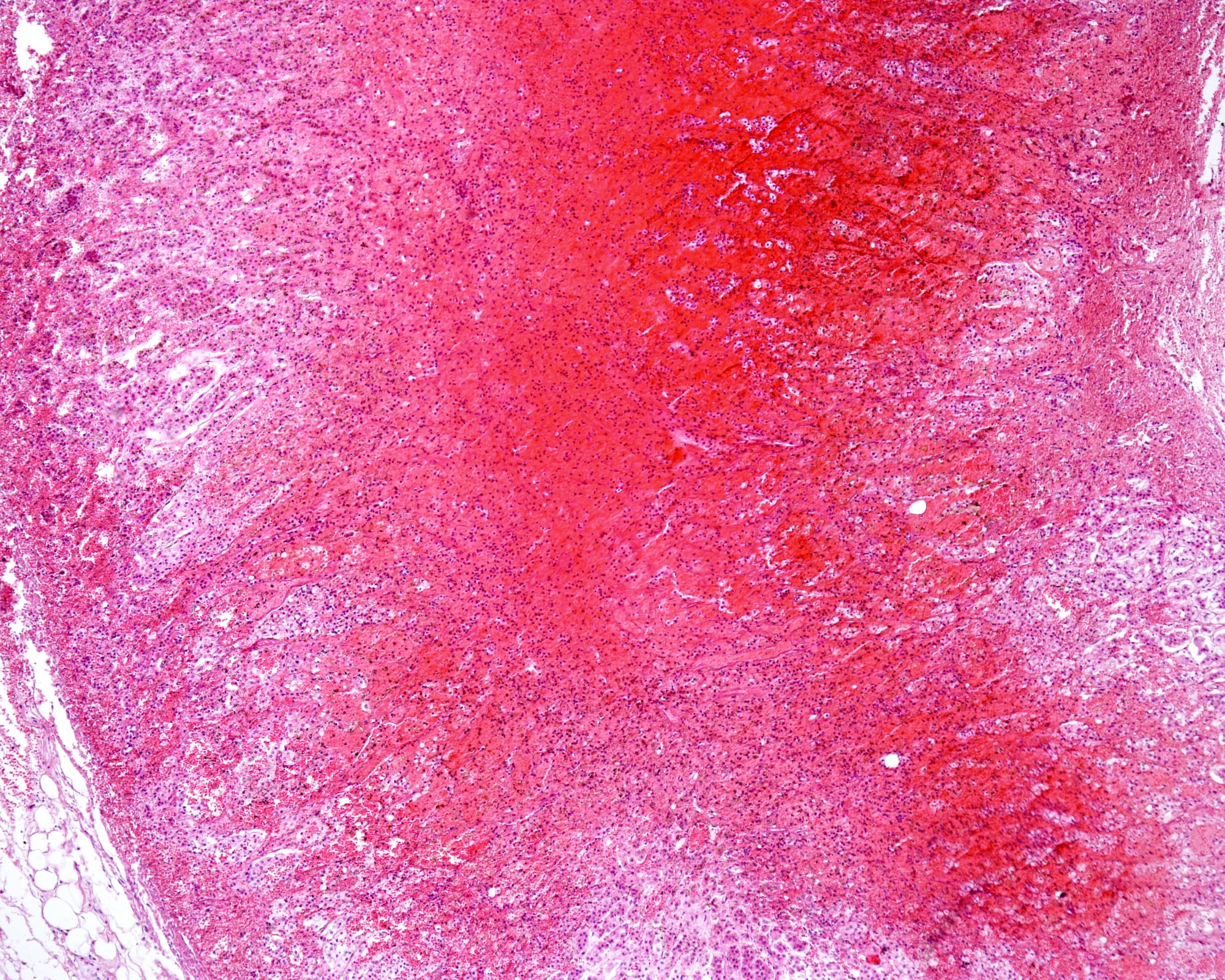 Neonatal Adrenal Haemorrhage Mimicking Acute Scrotum: A Case Report