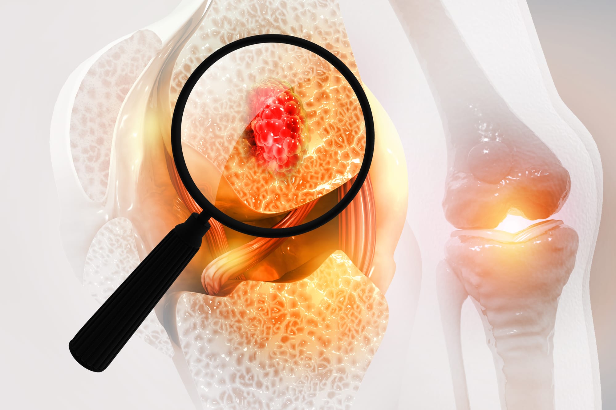 Novel Oncologic Strategies in Osteosarcoma Management: Maximizing Impact, Minimizing Harm