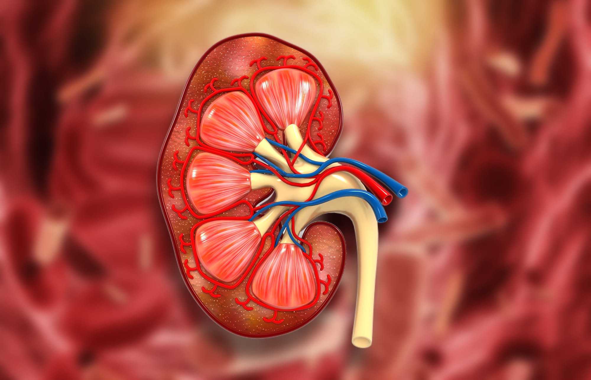 Xanthogranulomatous Pyelonephritis in the Tropics