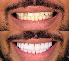 Faceta e Lente de Contato Dental
