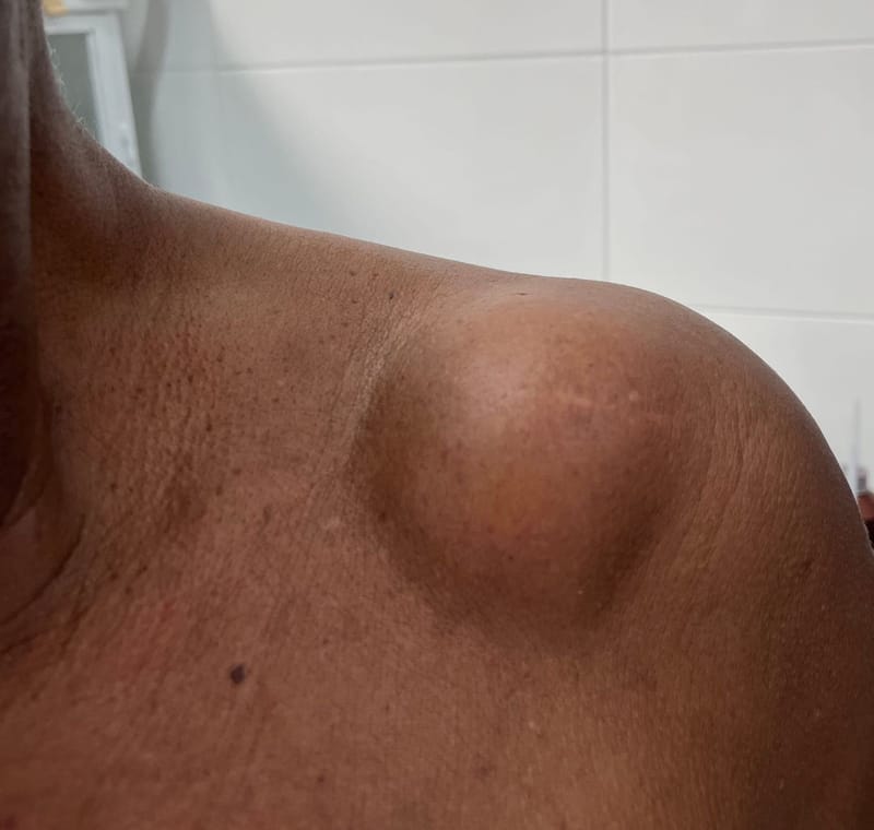 Remoção de Lipomas