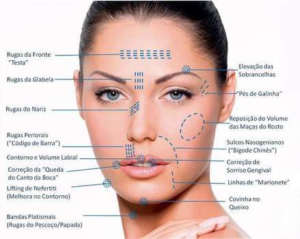 Preenchimento Facial com Ácido Hialurônico