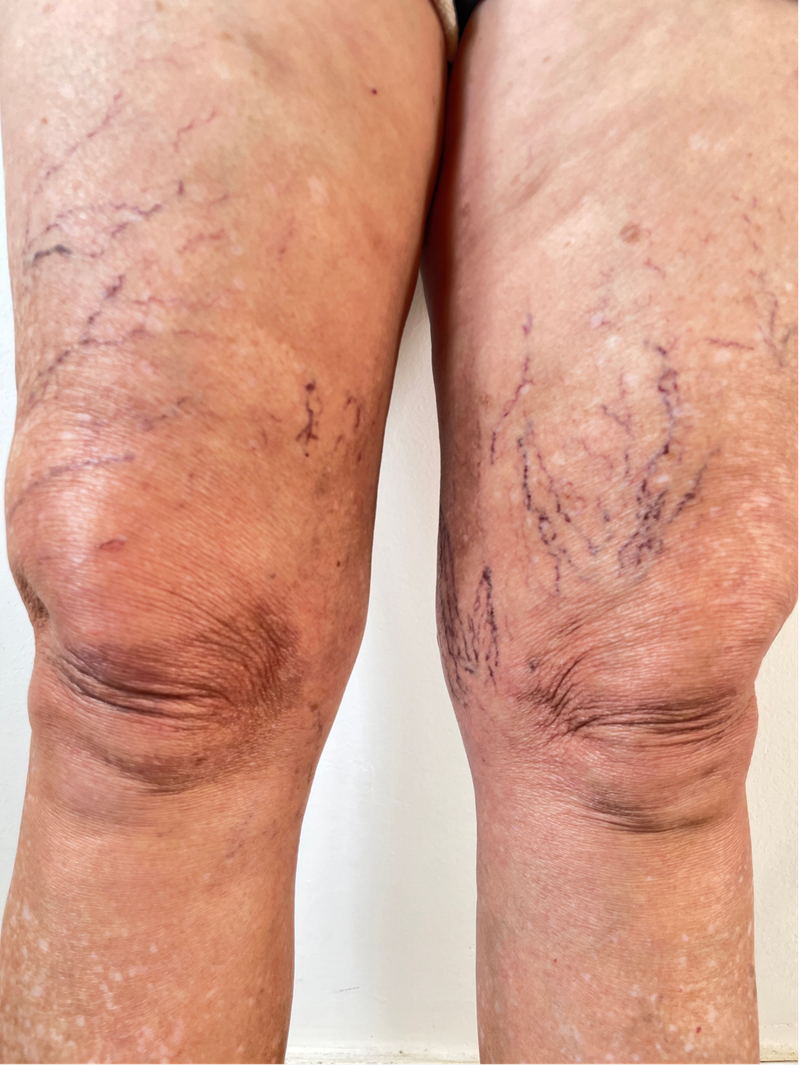 Tratamento de Varizes