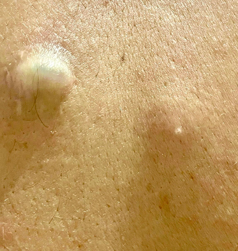 Remoção de Cisto Sebáceo