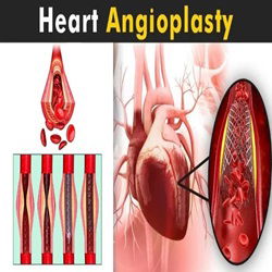 Angioplasty Surgery