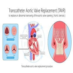 Transcatheter Aortic Valve Replacement
