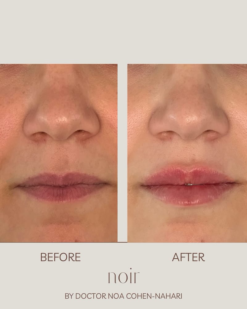 עיצוב שפתיים בחומצה היאלורונית