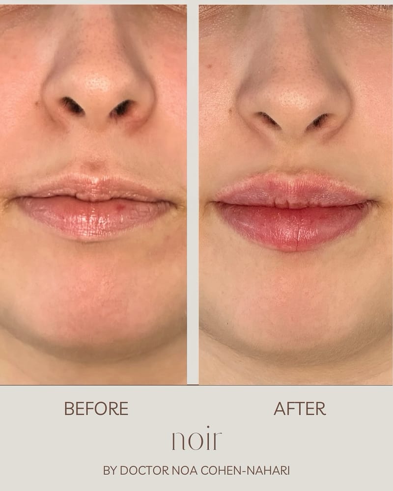 עיצוב שפתיים בחומצה היאלורונית