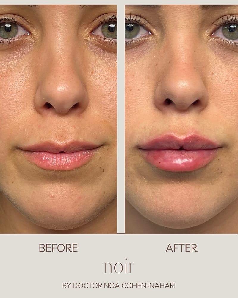 עיצוב שפתיים בחומצה היאלורונית