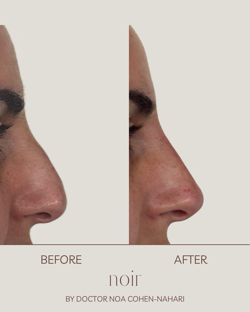 פיסול אף בחומצה היאלורונית