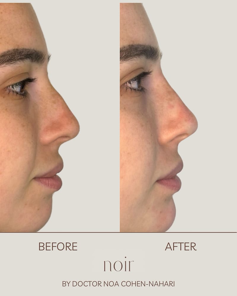 פיסול אף בחומצה היאלורונית