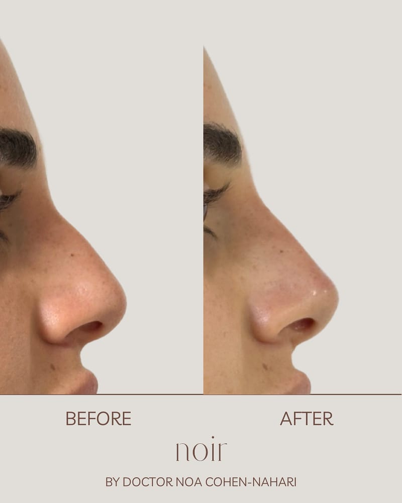 פיסול אף בחומצה היאלורונית