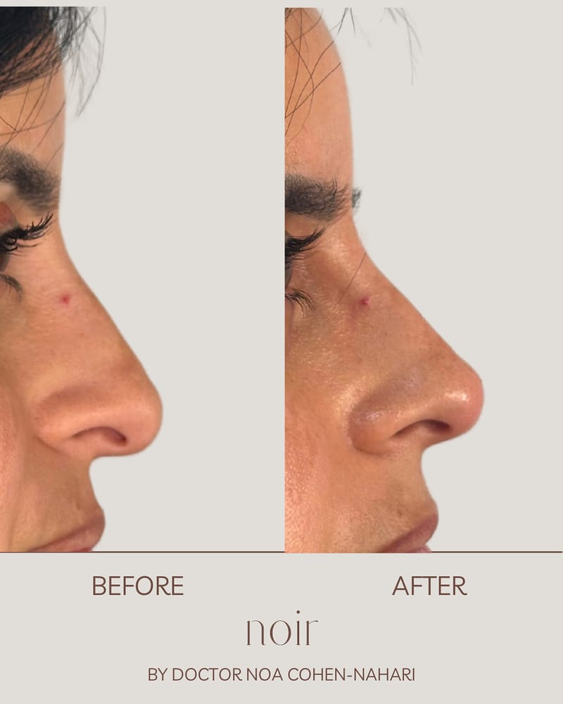 פיסול אף בחומצה היאלורונית