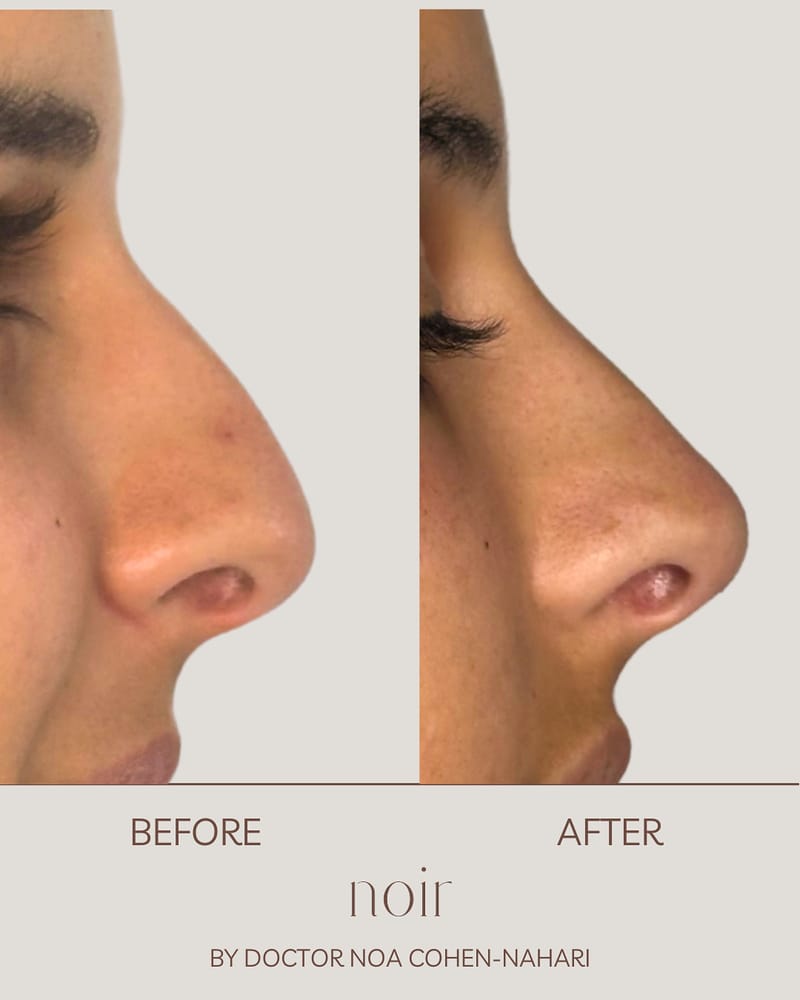 פיסול אף בחומצה היאלורונית