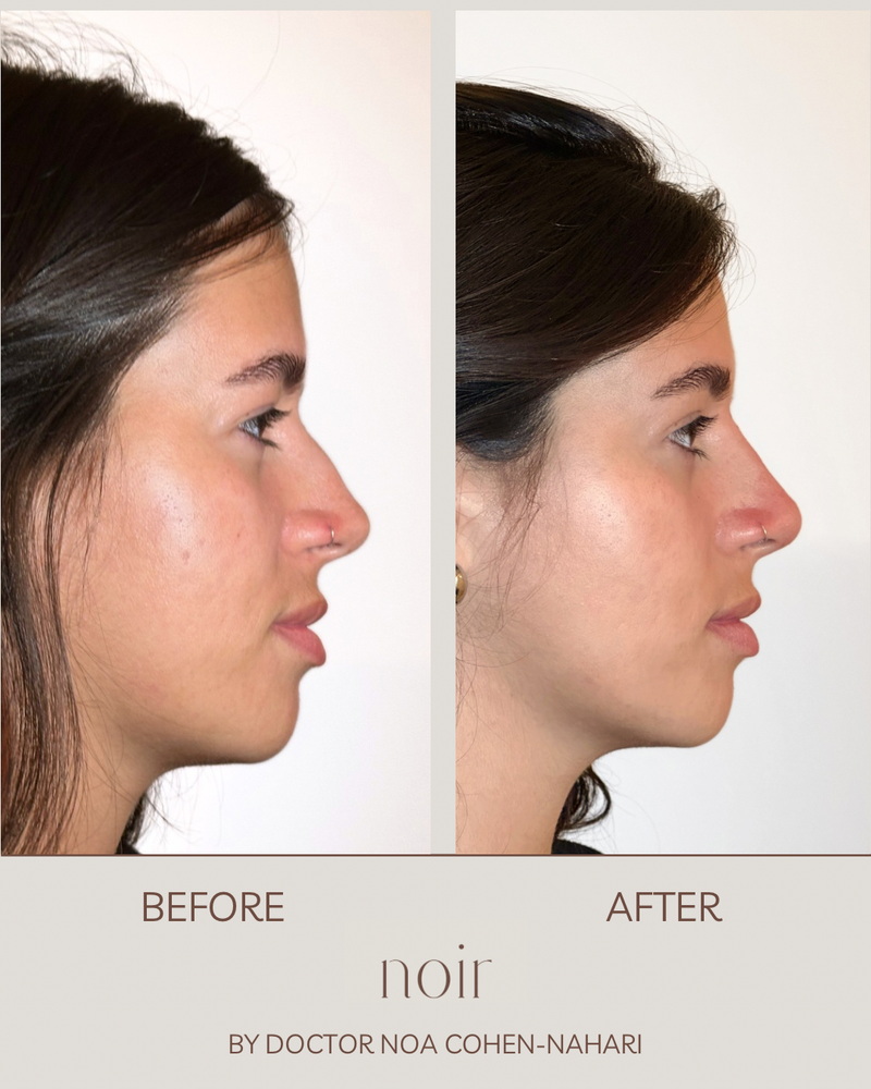 פיסול אף בחומצה היאלורונית