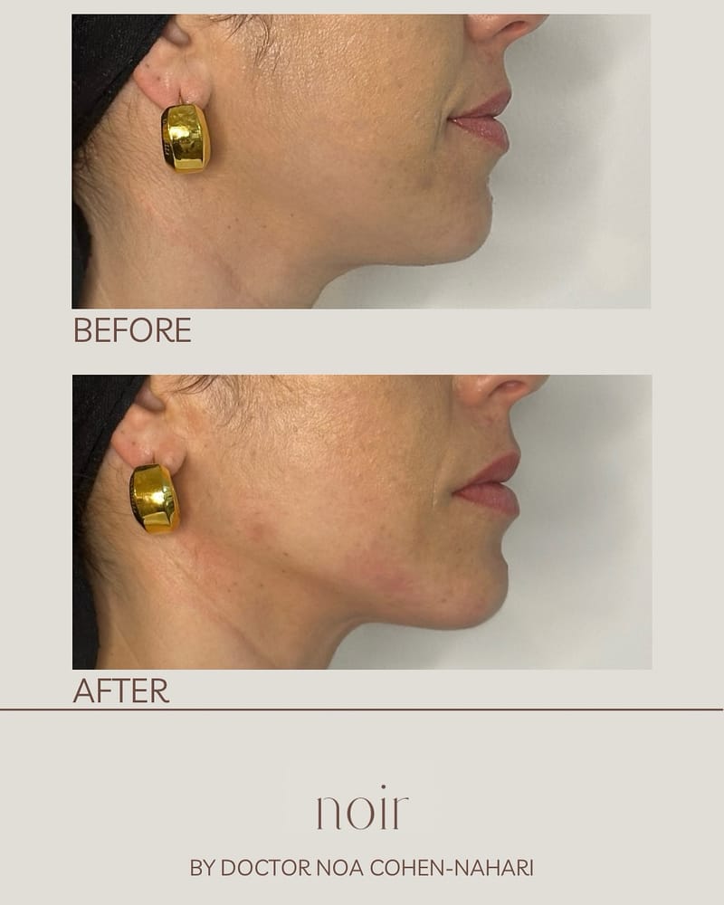 הזרקת חומצה היאלורונית בהתאמה אישית