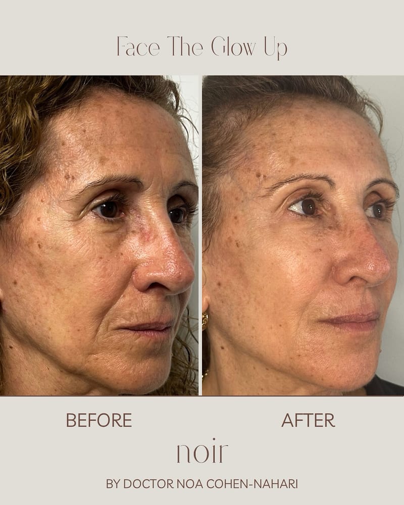 הזרקת חומצה היאלורונית בהתאמה אישית