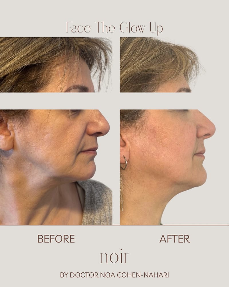 הזרקת חומצה היאלורונית בהתאמה אישית