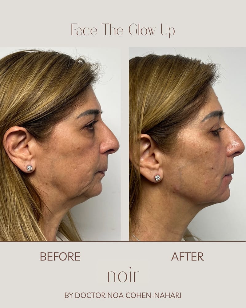 הזרקת חומצה היאלורונית בהתאמה אישית