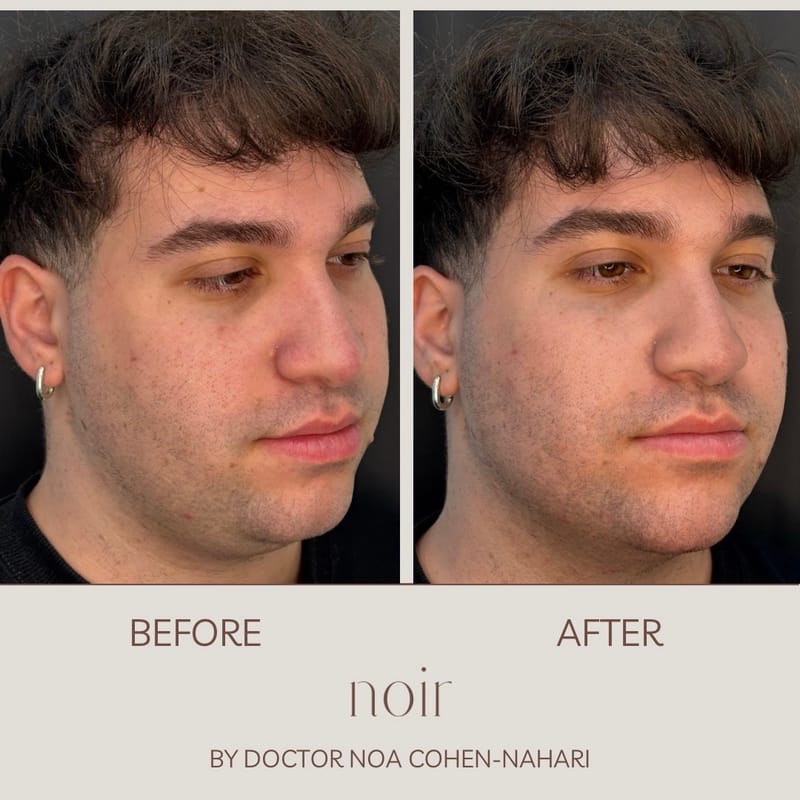 הזרקת חומצה היאלורונית בהתאמה אישית