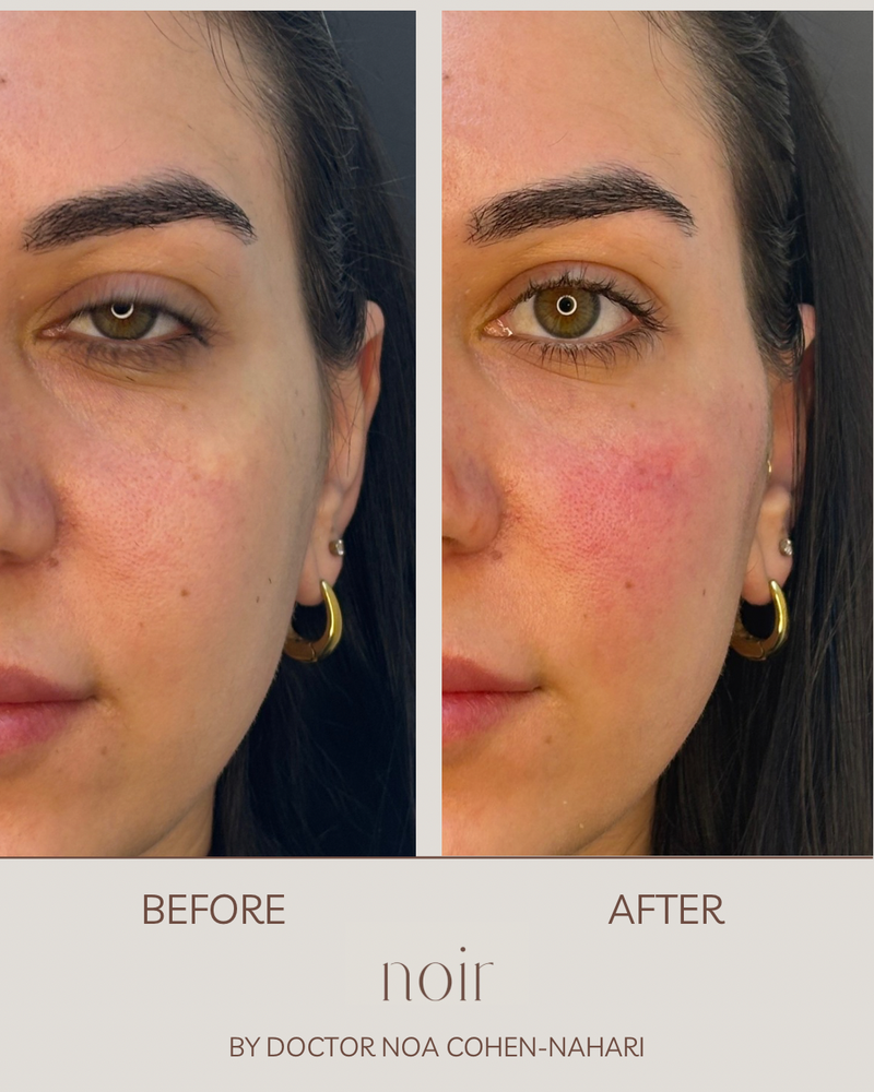 הזרקת חומצה היאלורונית בהתאמה אישית