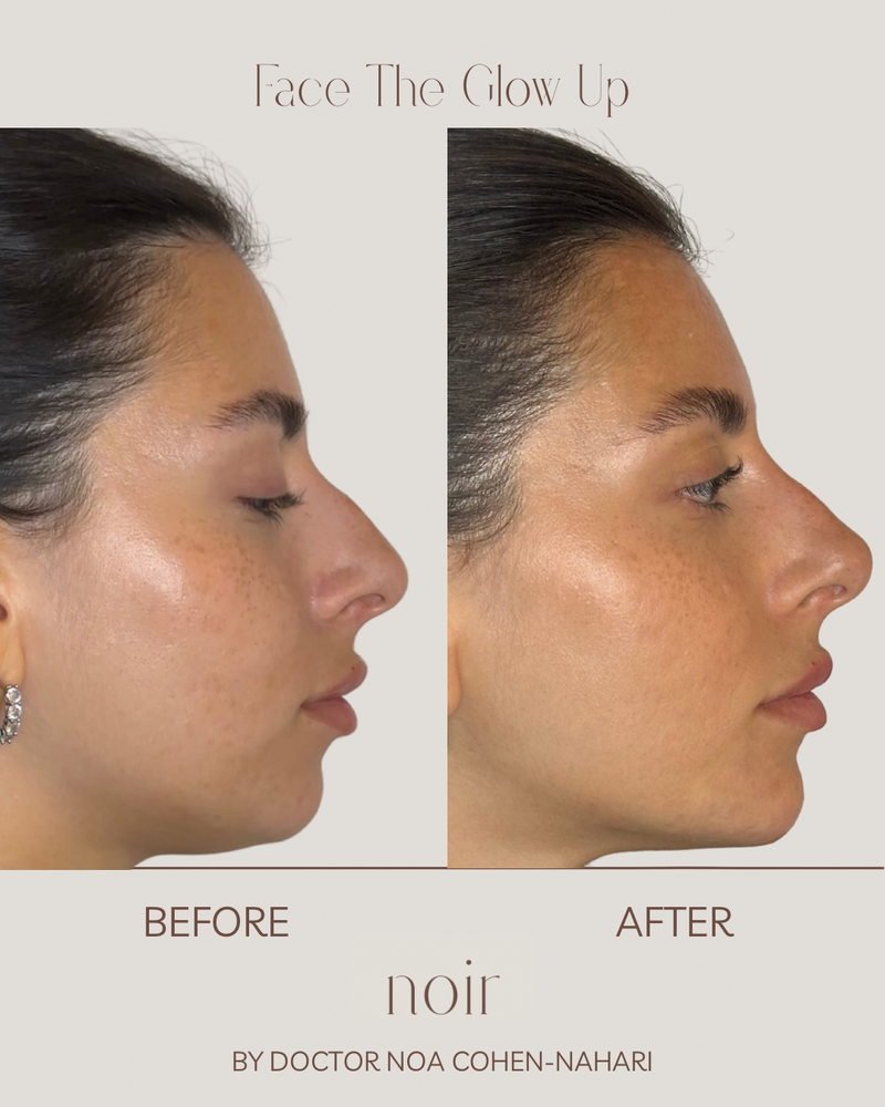 FACE THE GLOW UP הטיפול הייחודי של קליניקת NOIR