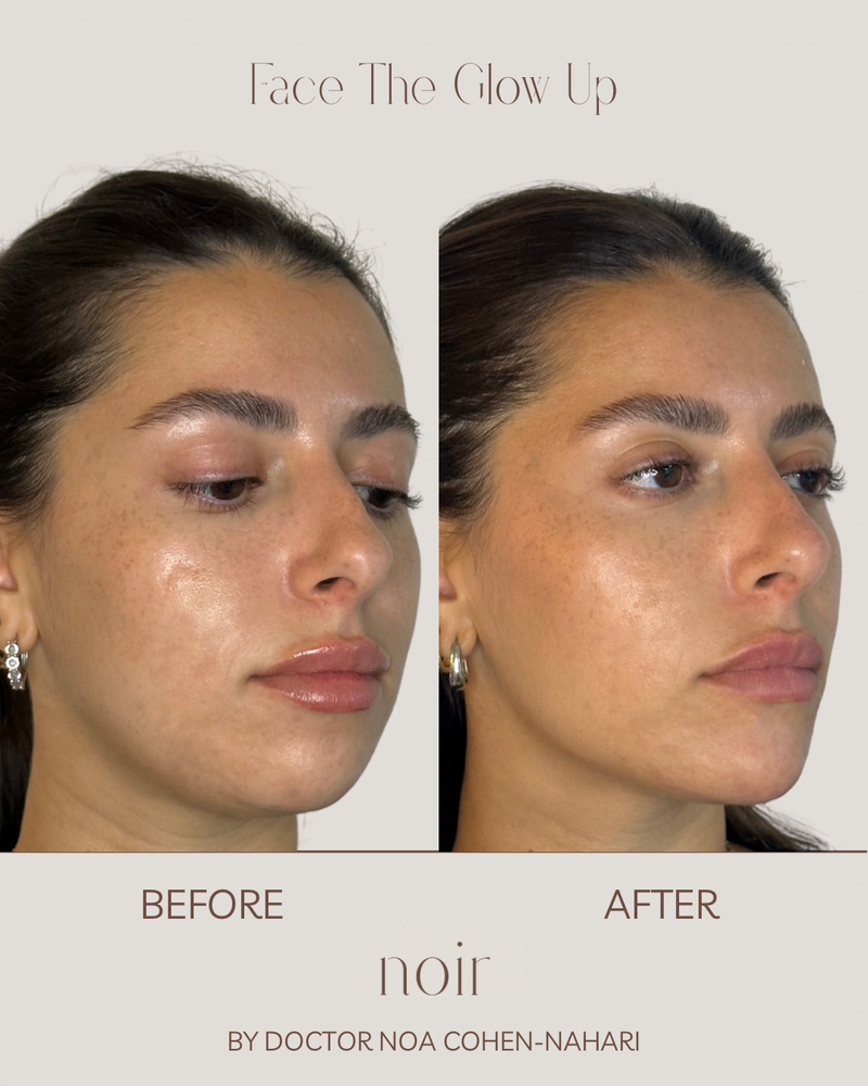 הזרקת חומצה היאלורונית בהתאמה אישית