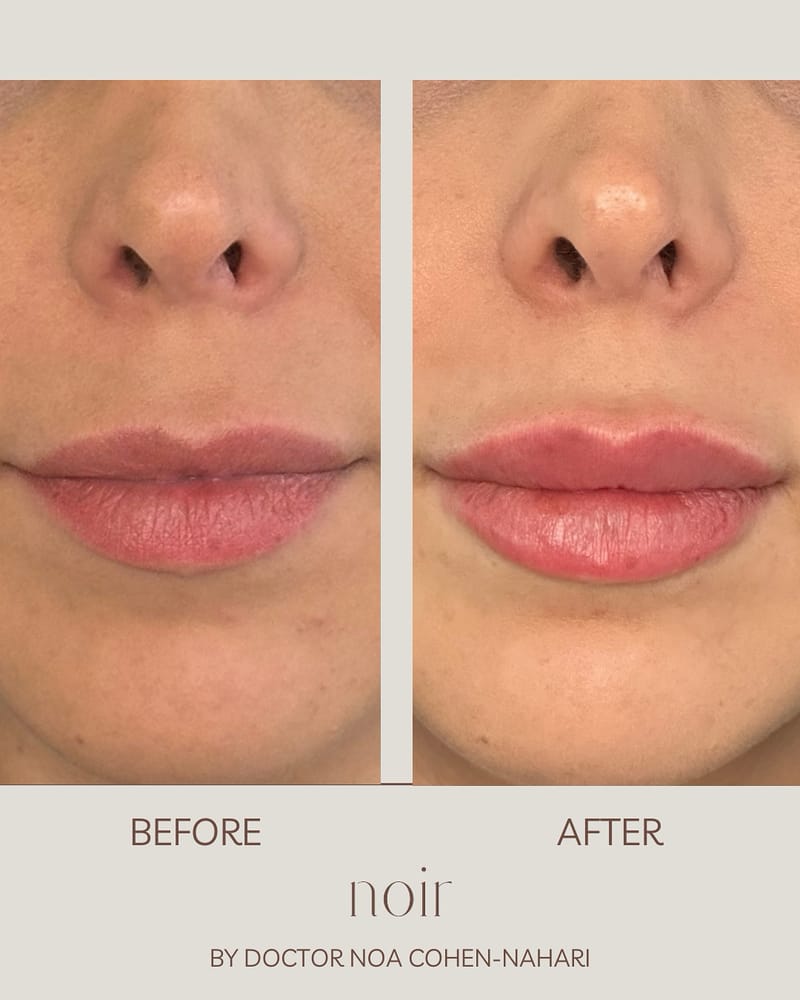 עיצוב שפתיים בחומצה היאלורונית