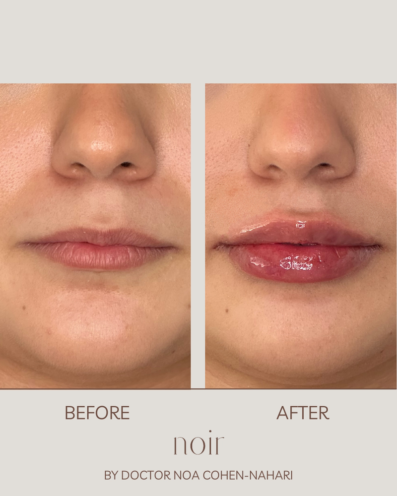 עיצוב שפתיים בחומצה היאלורונית