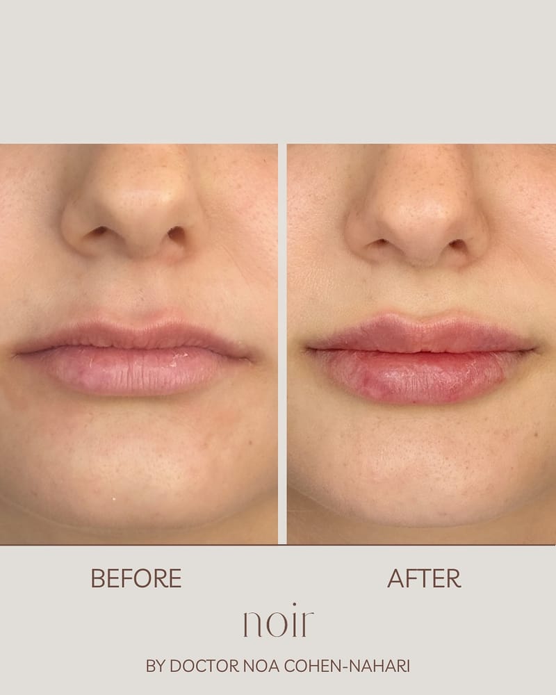 עיצוב שפתיים בחומצה היאלורונית