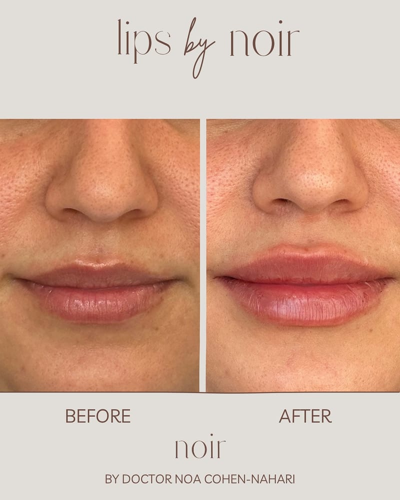 עיצוב שפתיים בחומצה היאלורונית