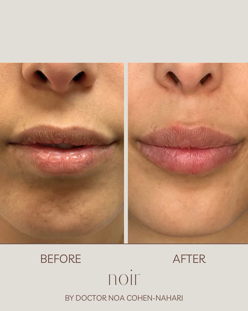 עיצוב שפתיים בחומצה היאלורונית