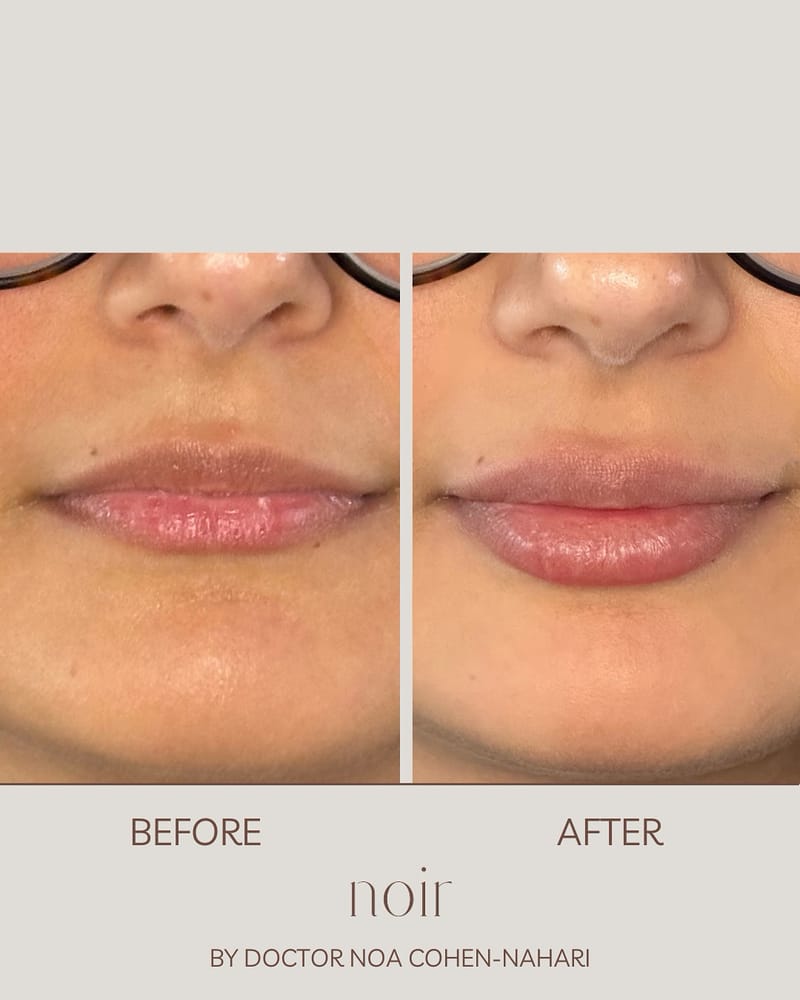 עיצוב שפתיים בחומצה היאלורונית