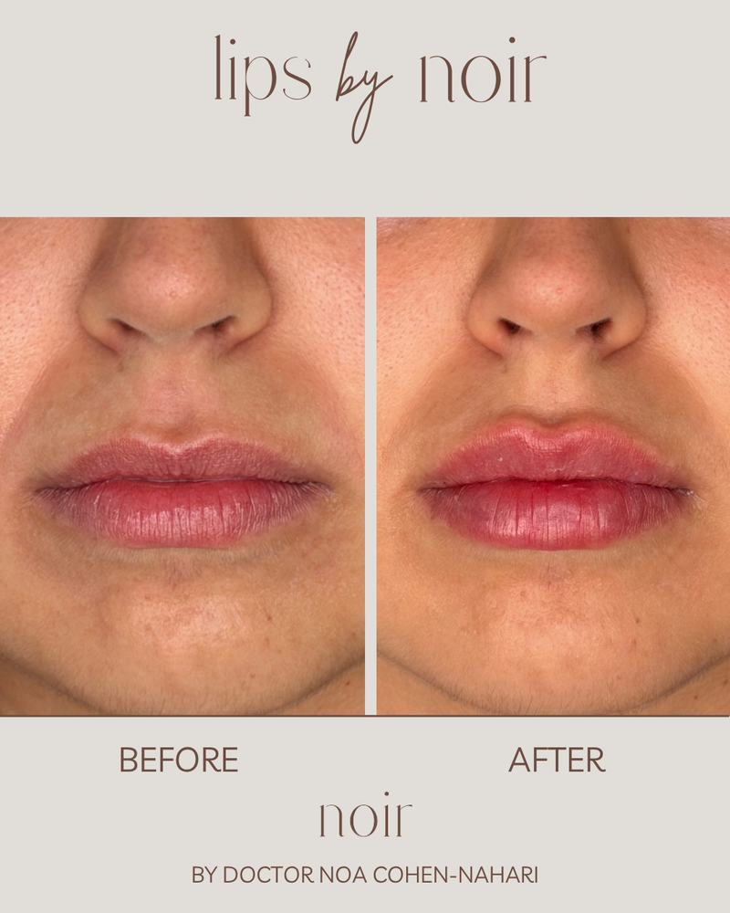 עיצוב שפתיים בחומצה היאלורונית