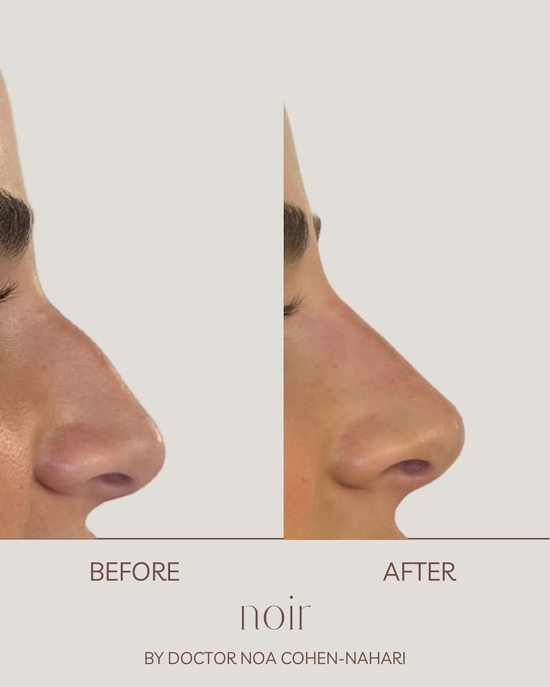 פיסול אף בחומצה היאלורונית