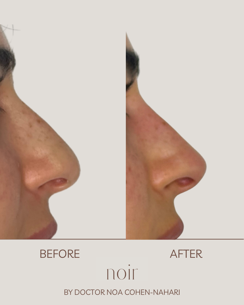 פיסול אף בחומצה היאלורונית