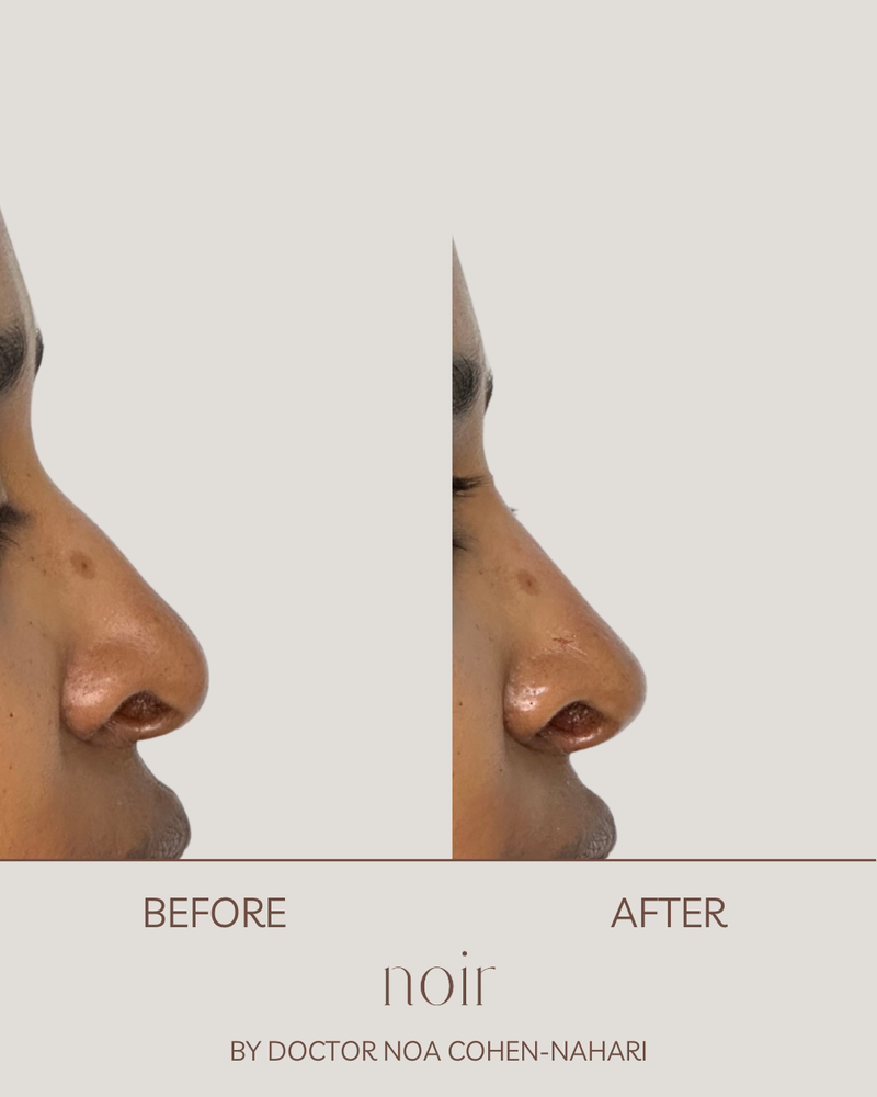 פיסול אף בחומצה היאלורונית