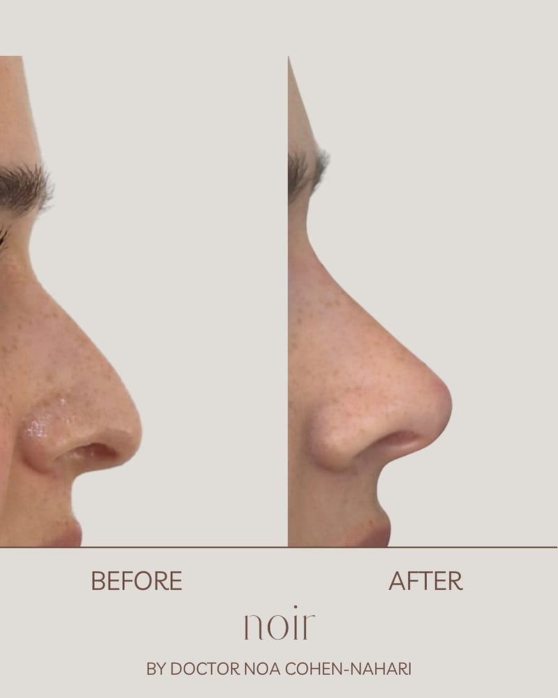 פיסול אף בחומצה היאלורונית