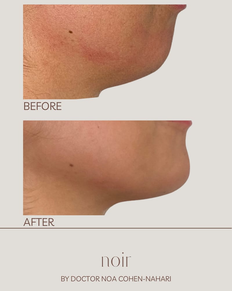 הזרקת חומצה היאלורונית בהתאמה אישית