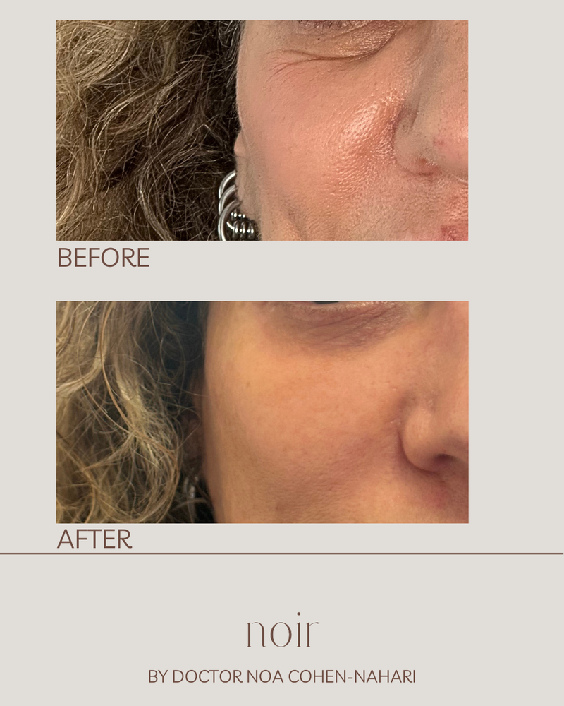 הזרקת חומצה היאלורונית בהתאמה אישית