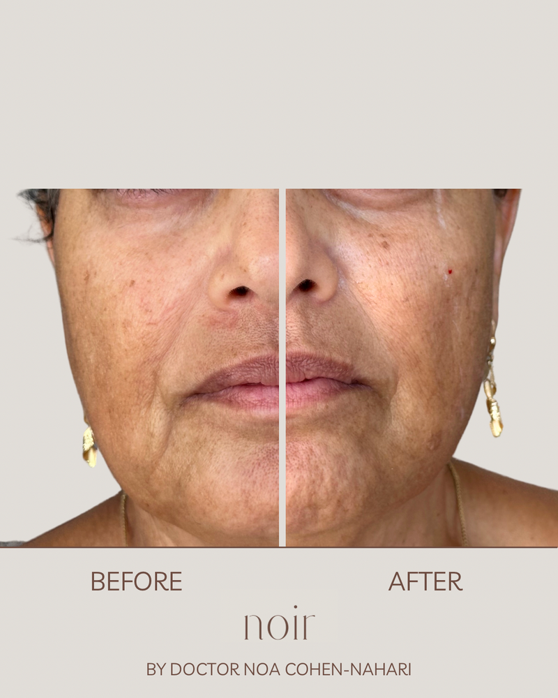 הזרקת חומצה היאלורונית בהתאמה אישית