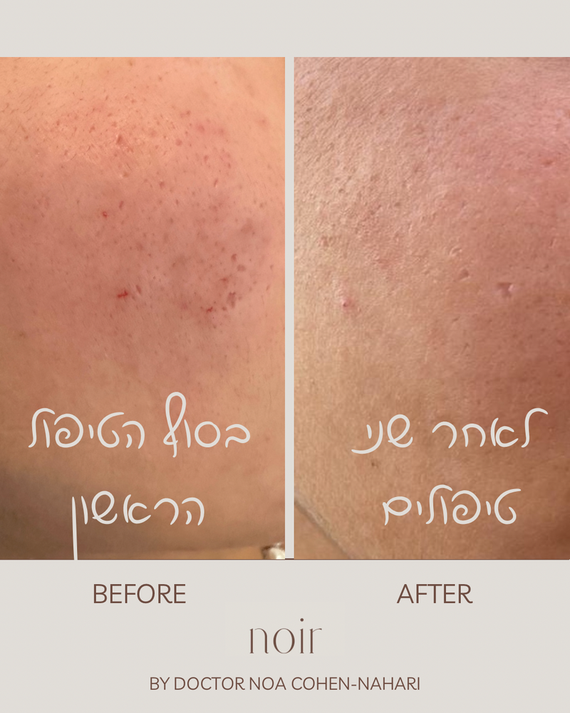 טיפול בצלקות אקנה