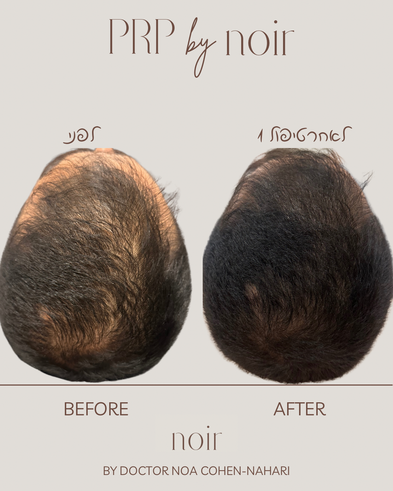 טיפול בהקרחה גברית ונשית, דלילות ונשירת שיער מוגברת