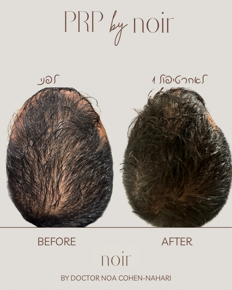 טיפול בהקרחה גברית ונשית, דלילות ונשירת שיער מוגברת