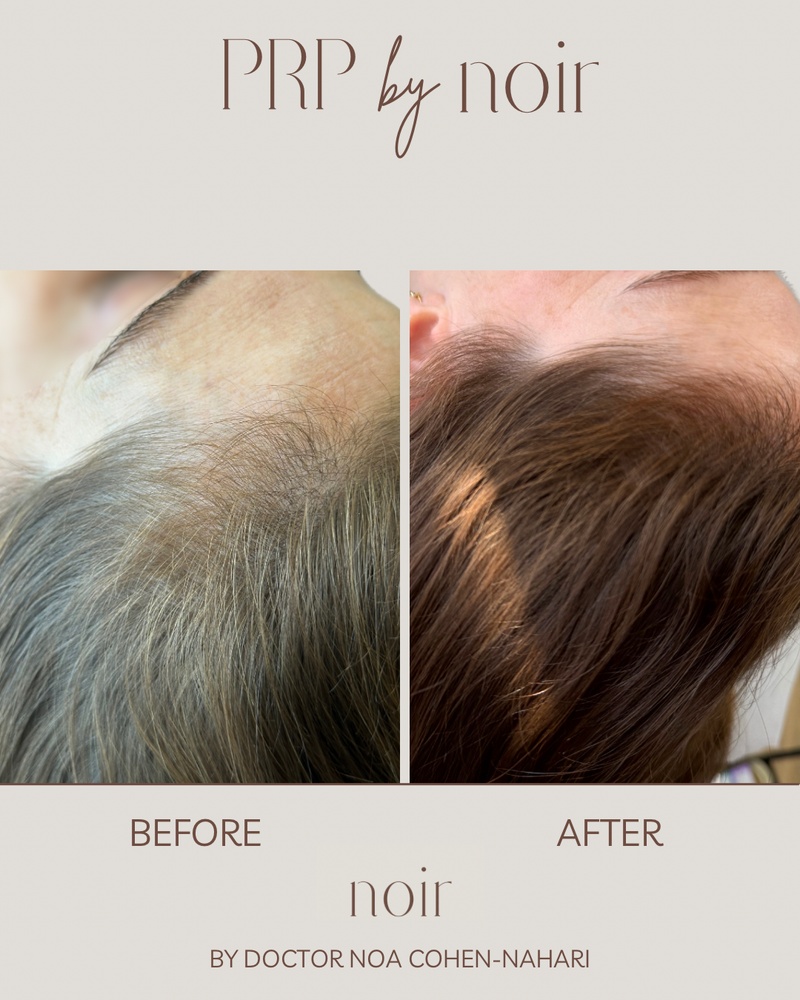 טיפול בהקרחה גברית ונשית, דלילות ונשירת שיער מוגברת