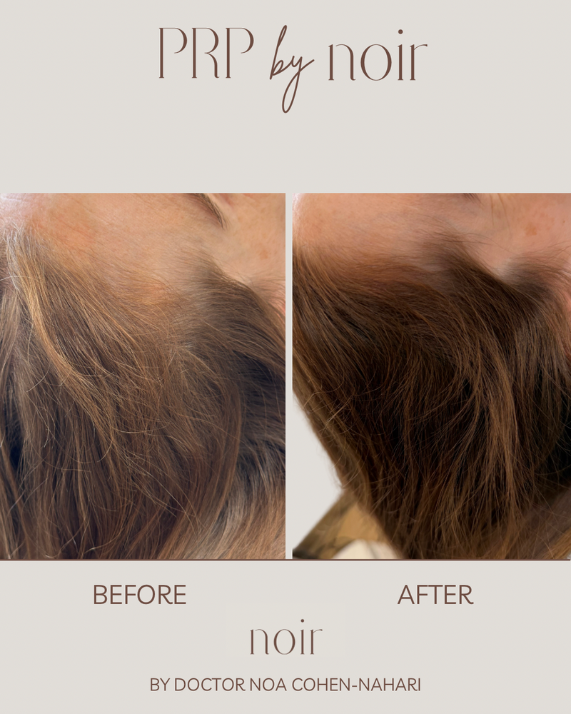 טיפול בהקרחה גברית ונשית, דלילות ונשירת שיער מוגברת