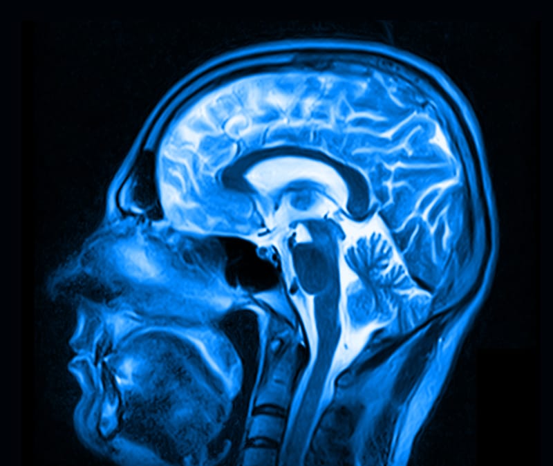 Transcranial Magnetic Stimulation